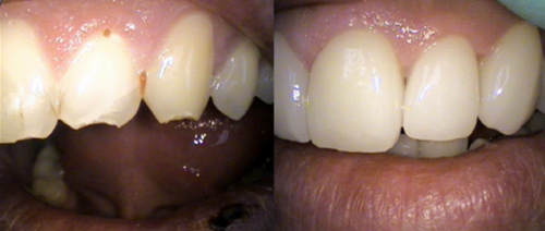 Before and After Dental Crowns | Marquis Family Dentistry | Katy TX