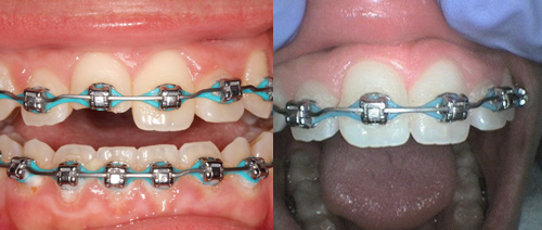 Before and After Smile | Marquis Family Dentistry | Katy TX