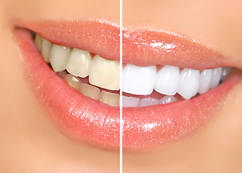 teeth-whitening-katy-texas
